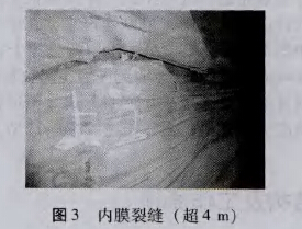 内膜裂缝(超4 m)