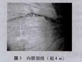 内膜裂缝(超4 m) 内膜裂缝(超4 m)